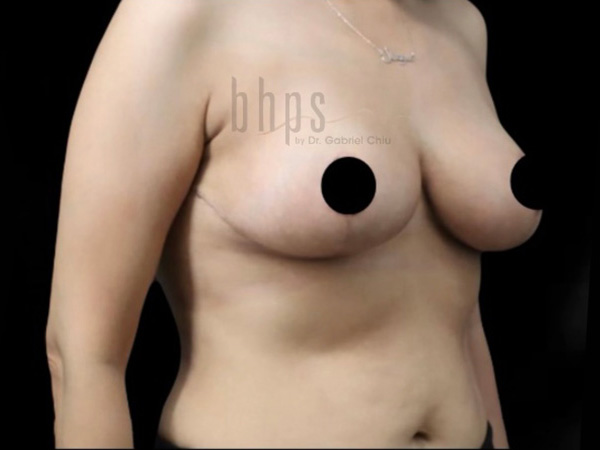 Procedure result at Beverly Hills Plastic Surgery