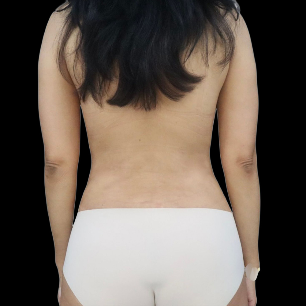 Beverly Hills Plastic Surgery liposuction after — Beverly Hills, CA