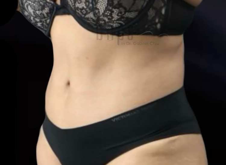 Beverly Hills Plastic Surgery liposuction after — Beverly Hills, CA