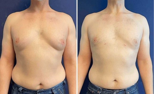A result from Partington Plastic Surgery and Laser Center