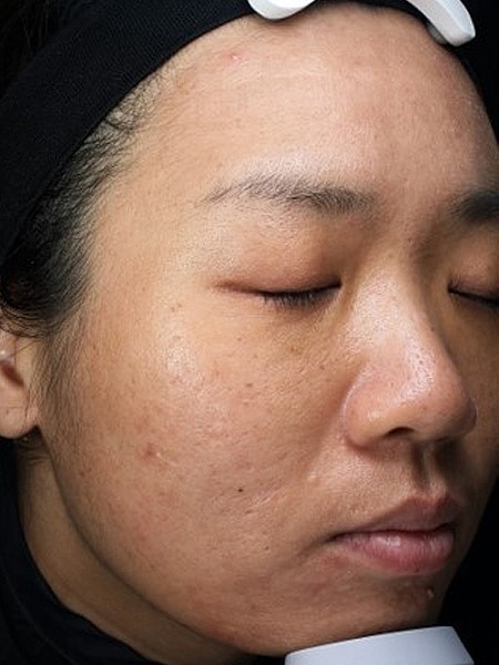 A result from Miami Skin and Vein (Shaun Patel, MD)