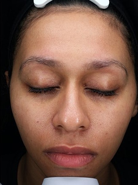 A result from Miami Skin and Vein (Shaun Patel, MD)
