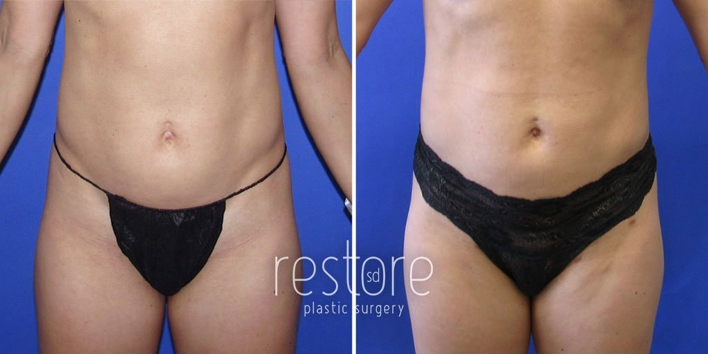 A result from Restore SD Plastic Surgery: Katerina Gallus, MD, FACS