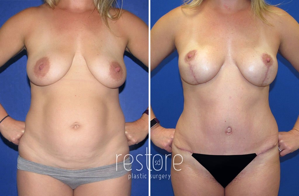 A result from Restore SD Plastic Surgery: Katerina Gallus, MD, FACS