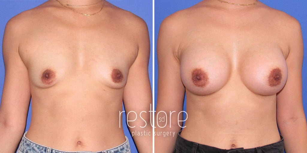 A result from Restore SD Plastic Surgery: Katerina Gallus, MD, FACS