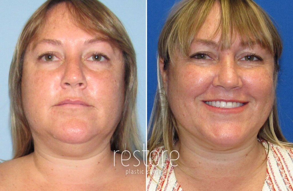 A result from Restore SD Plastic Surgery: Katerina Gallus, MD, FACS