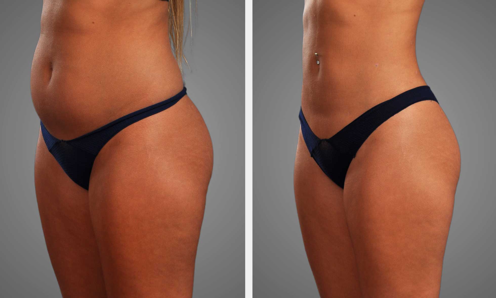 A result from Infini Phoenix Liposuction
