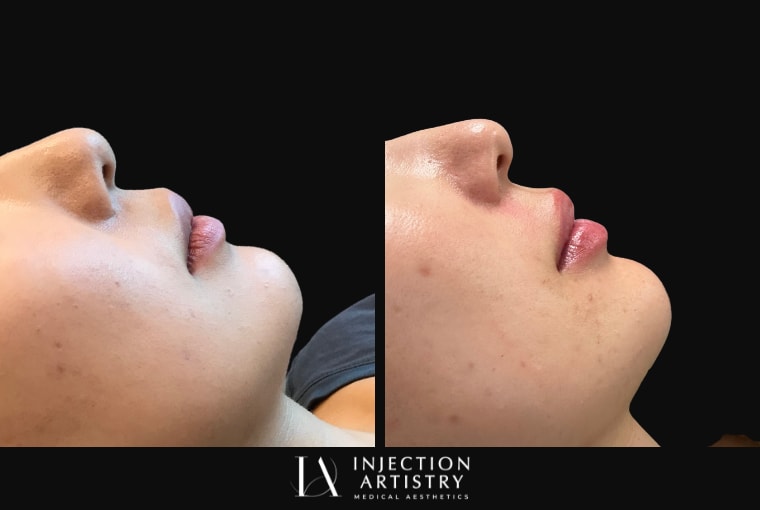 A result from Injection Artistry
