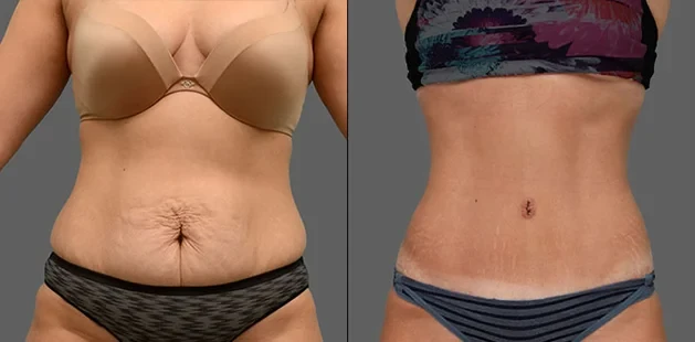 A result from Ditesheim Cosmetic Surgery