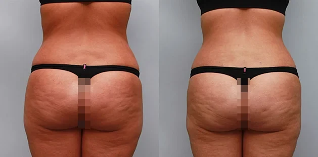 A result from Ditesheim Cosmetic Surgery