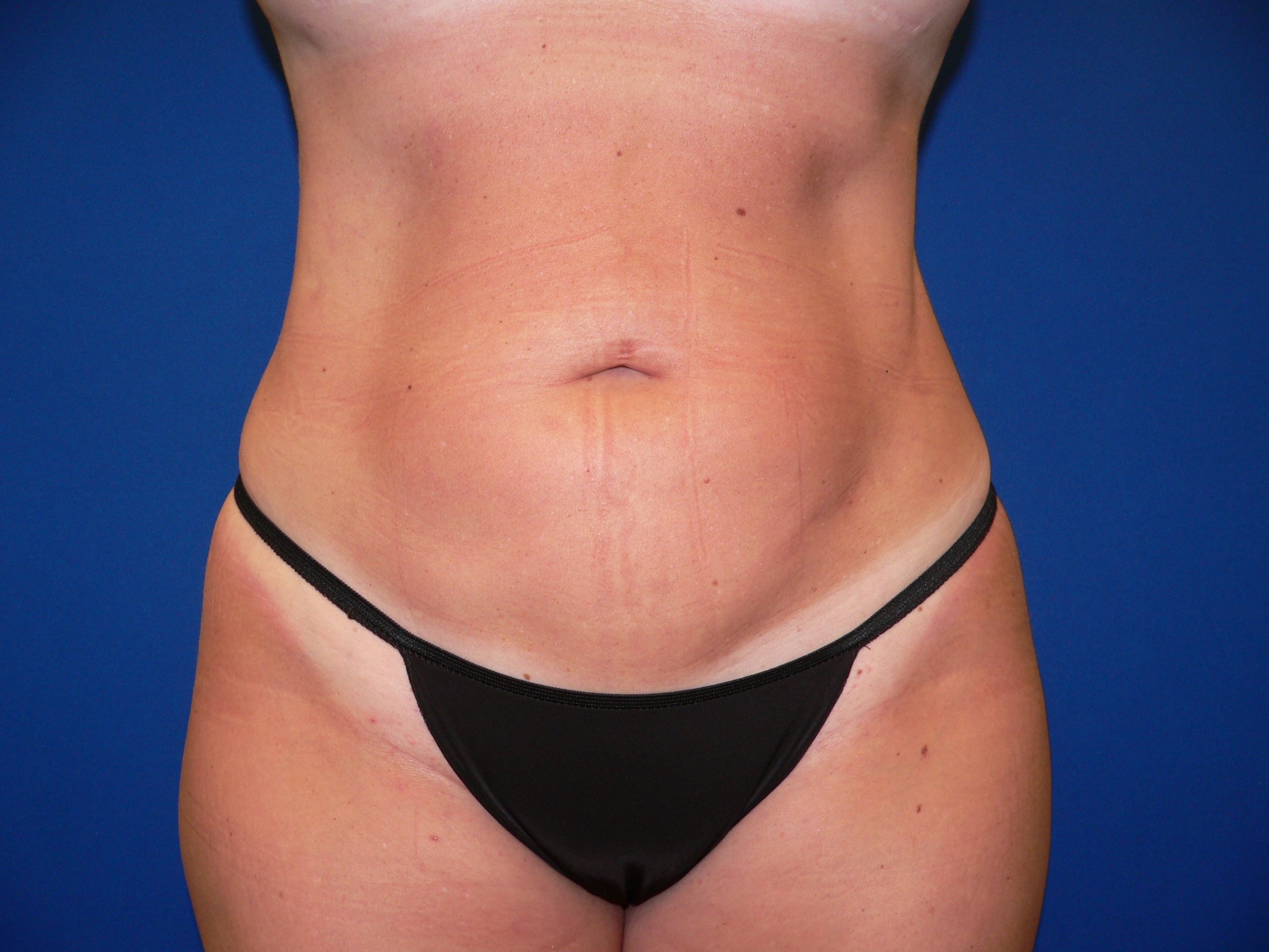 A result from DeConti Plastic Surgery