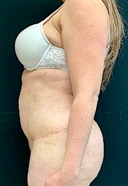 A result from Ogilvie Plastic Surgery