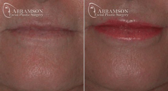 A result from Peter Jay Abramson, MD - Abramson Facial Plastic Surgery & Rejuvenation Center