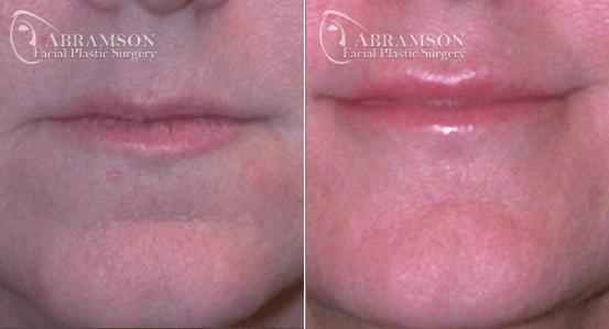A result from Peter Jay Abramson, MD - Abramson Facial Plastic Surgery & Rejuvenation Center