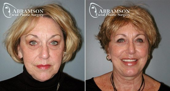 A result from Peter Jay Abramson, MD - Abramson Facial Plastic Surgery & Rejuvenation Center