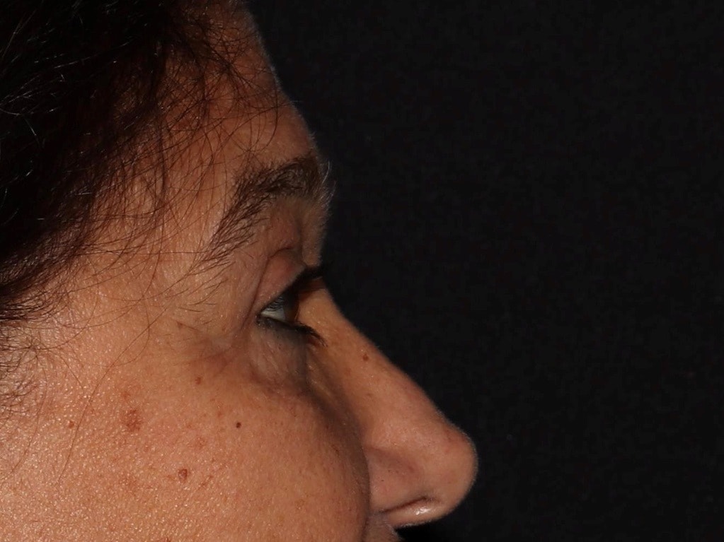 A result from Alexander Cosmetic Surgery