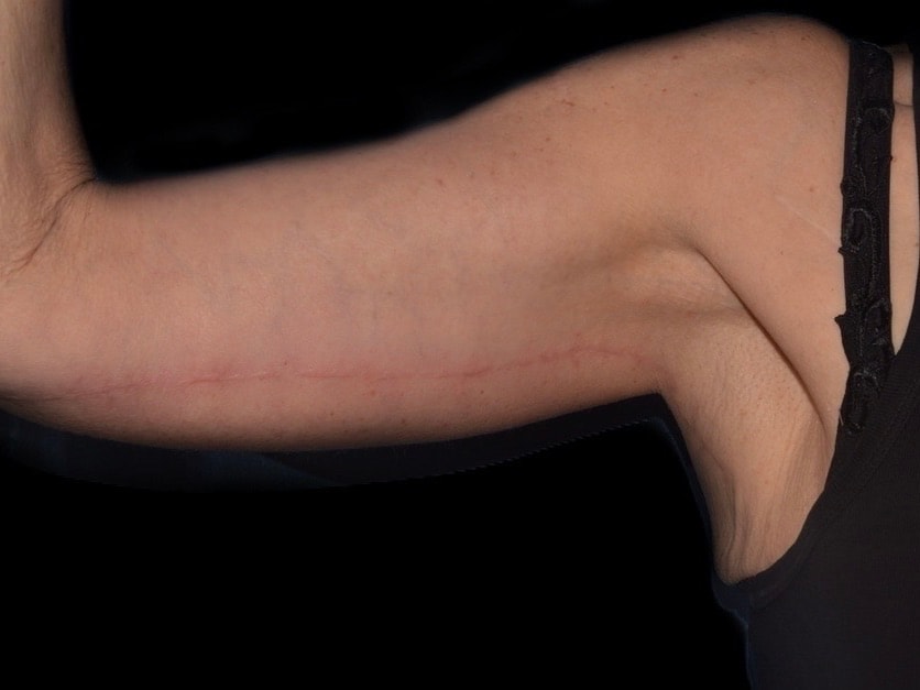 A result from Alexander Cosmetic Surgery