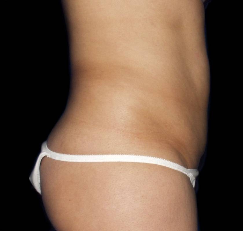 A result from Alexander Cosmetic Surgery