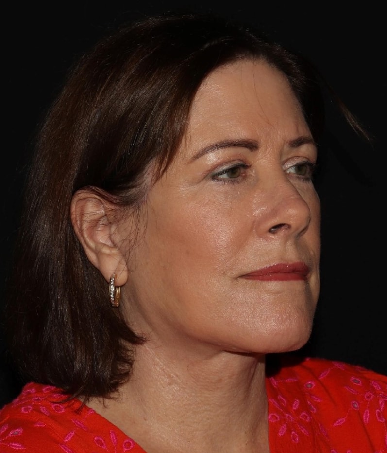 A result from Alexander Cosmetic Surgery