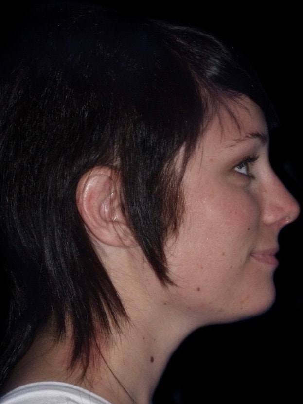 A result from Alexander Cosmetic Surgery