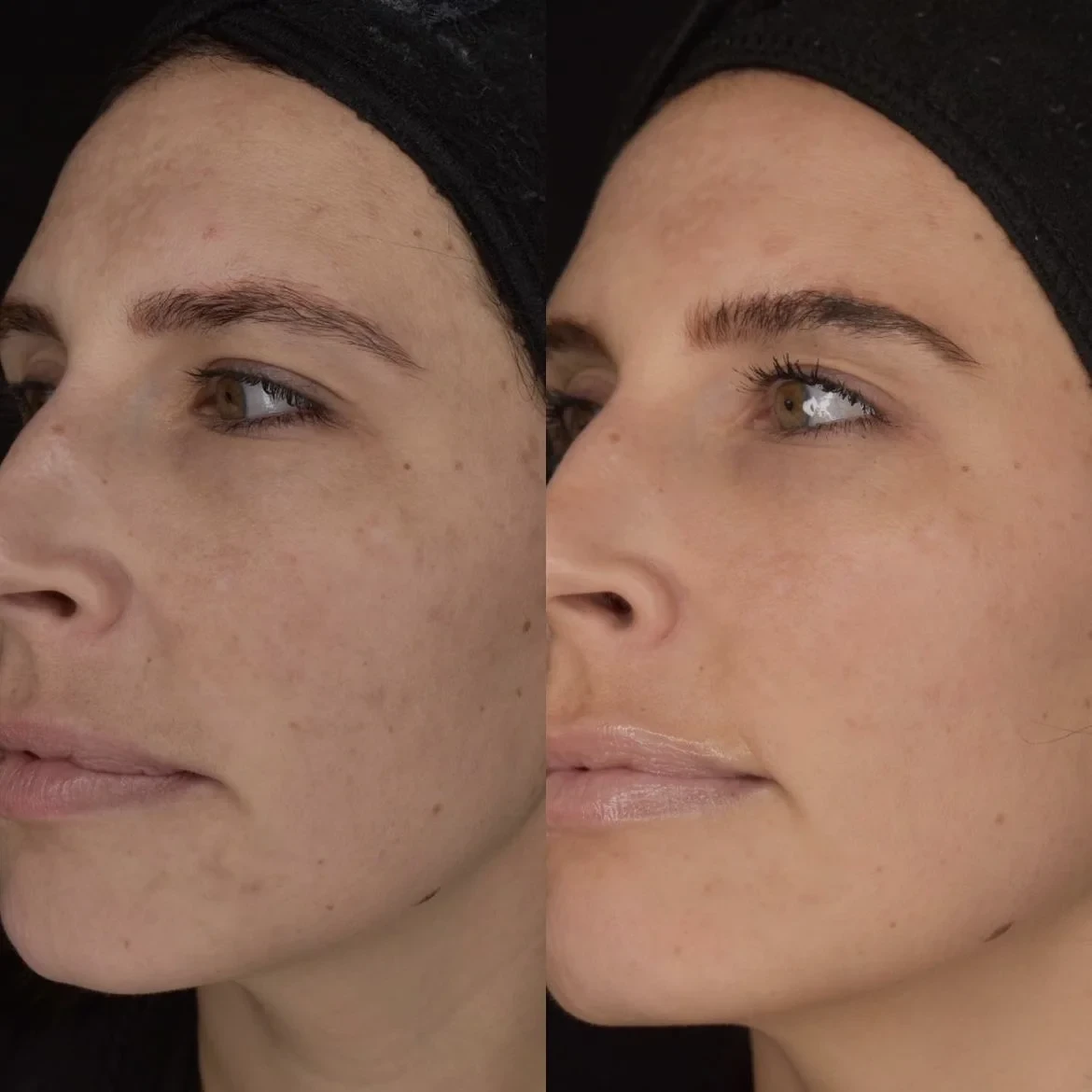 A result from Cosmedics MedSpa