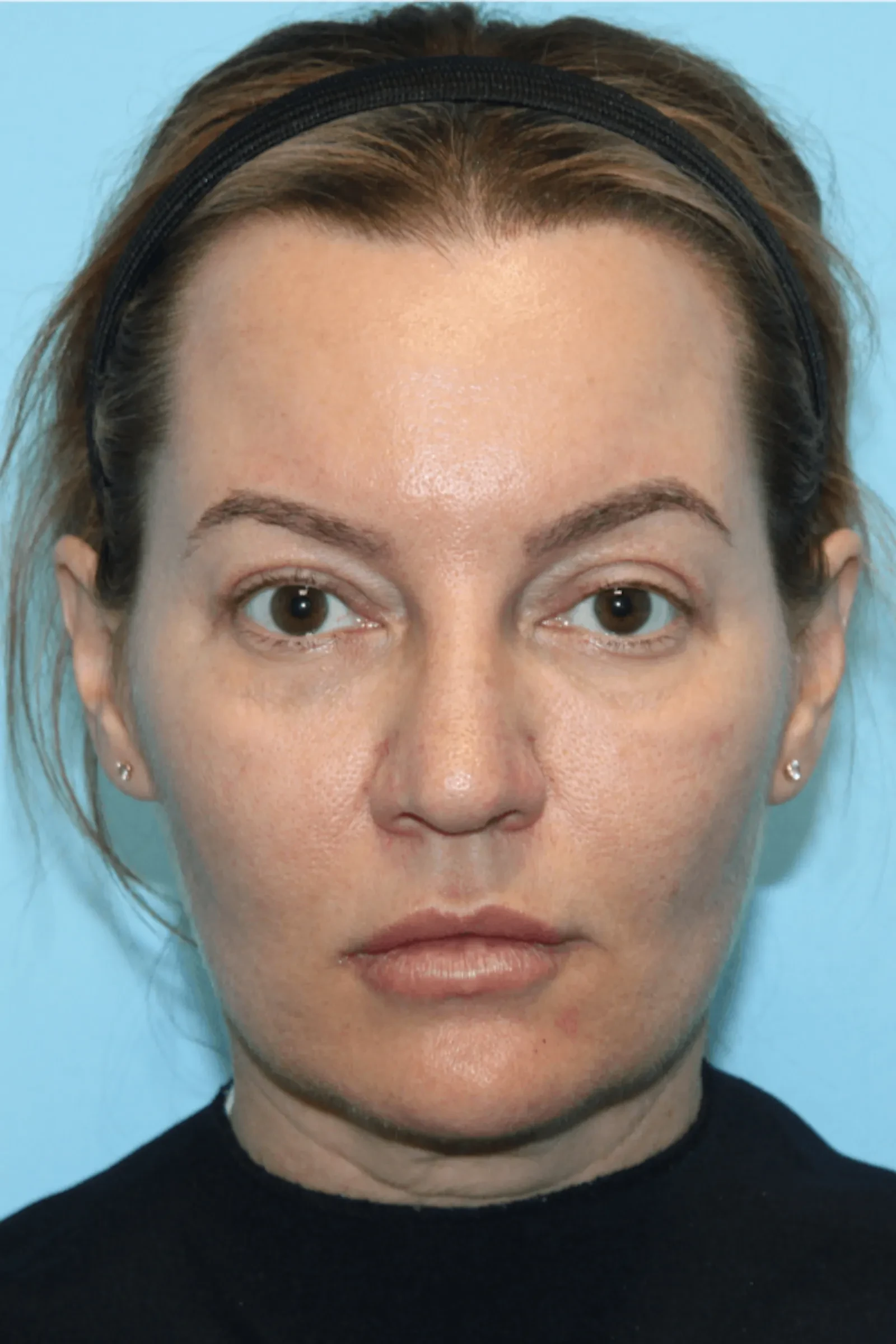 A result from Moradi MD Cosmetic Surgery