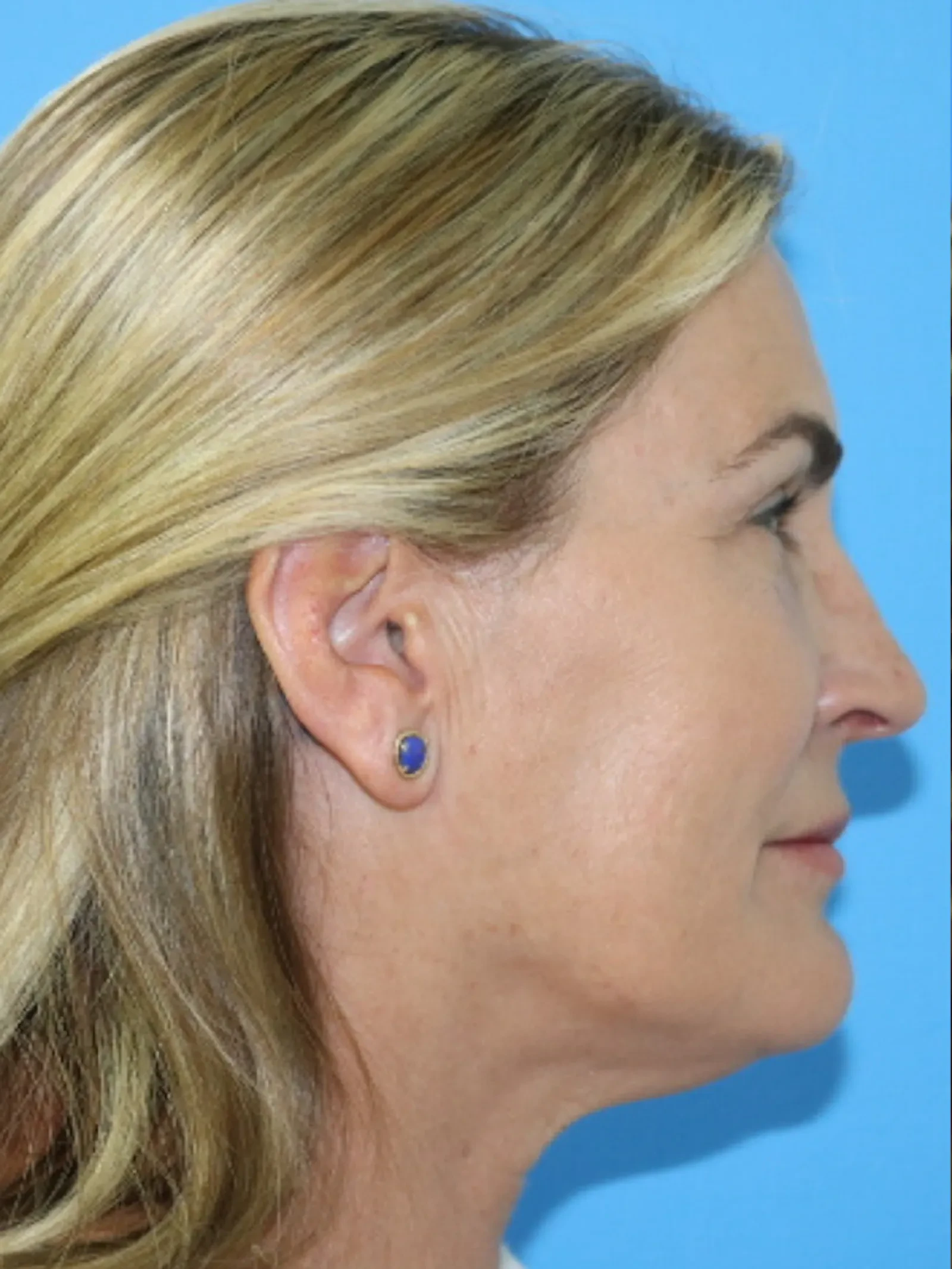 A result from Moradi MD Cosmetic Surgery