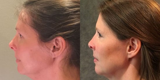 A result from Kristin J. Tarbet, MD, FACS