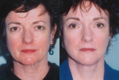 A result from Kristin J. Tarbet, MD, FACS