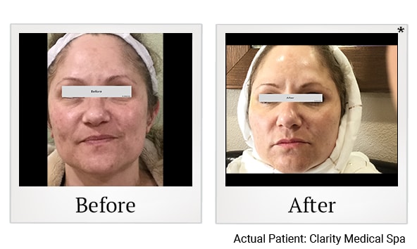 A result from Clarity Medical Spa - San Jose, Berryessa | PRP Hair Restoration, Injectables, Fillers, EZGel, Microneedling & Weight Loss