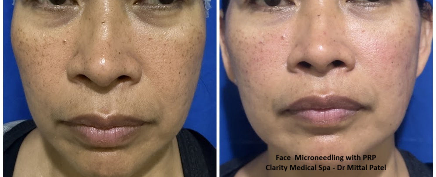 A result from Clarity Medical Spa - San Jose, Berryessa | PRP Hair Restoration, Injectables, Fillers, EZGel, Microneedling & Weight Loss