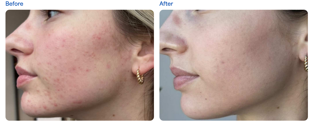 A result from Clarity Medical Spa - San Jose, Berryessa | PRP Hair Restoration, Injectables, Fillers, EZGel, Microneedling & Weight Loss