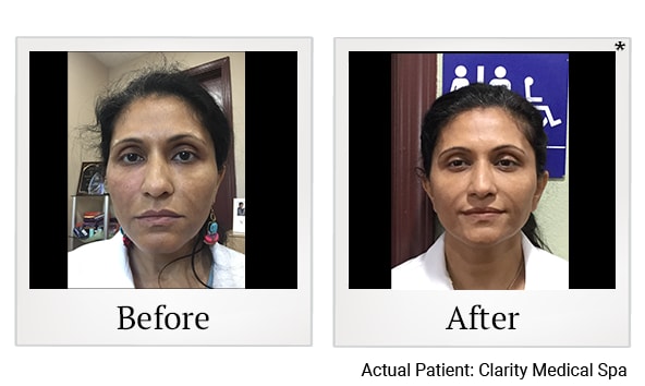 A result from Clarity Medical Spa - San Jose, Berryessa | PRP Hair Restoration, Injectables, Fillers, EZGel, Microneedling & Weight Loss