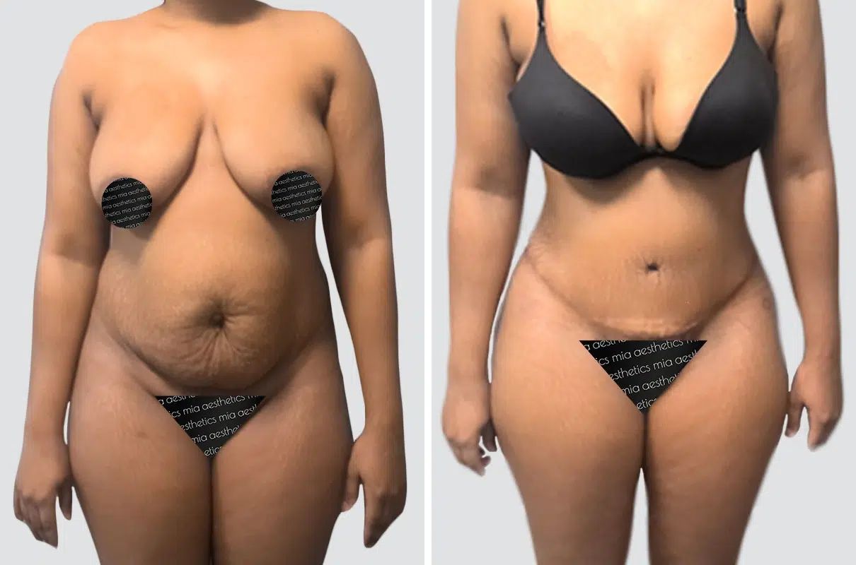 Tummy Tuck result at Mia Aesthetics