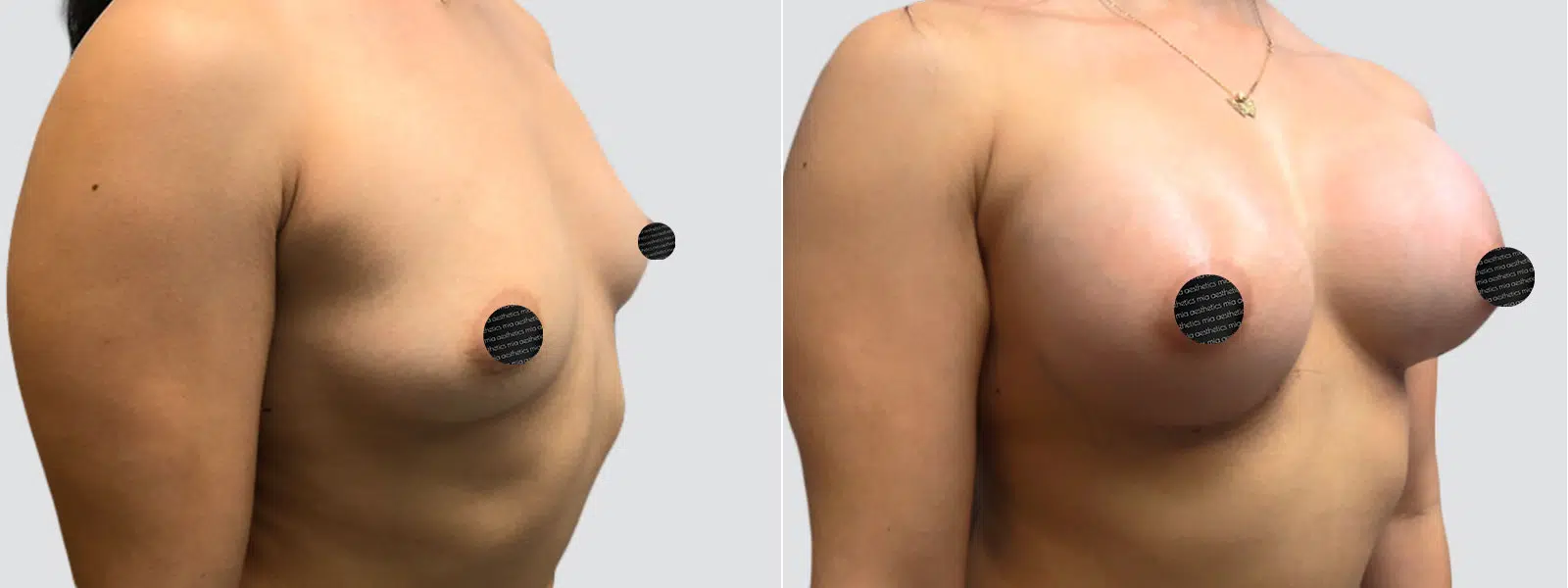 Breast Augmentation result at Mia Aesthetics