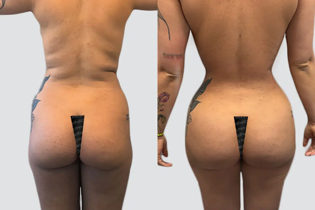 Bbl result at Mia Aesthetics