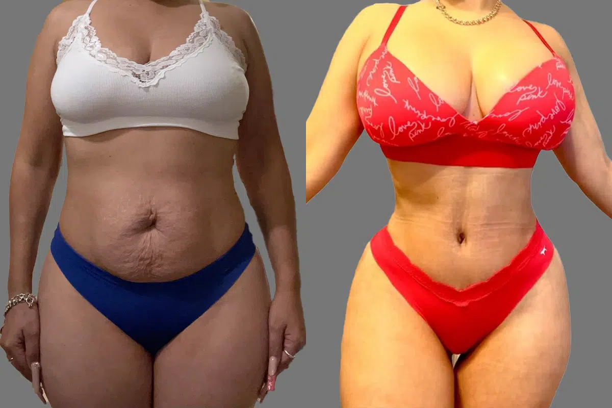 Mommy Makeover result at Mia Aesthetics