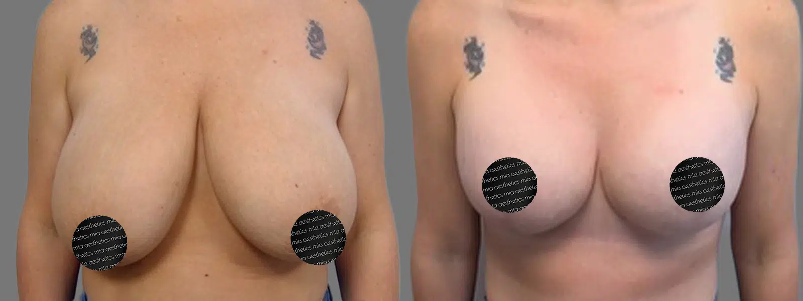 Breast Lift result at Mia Aesthetics