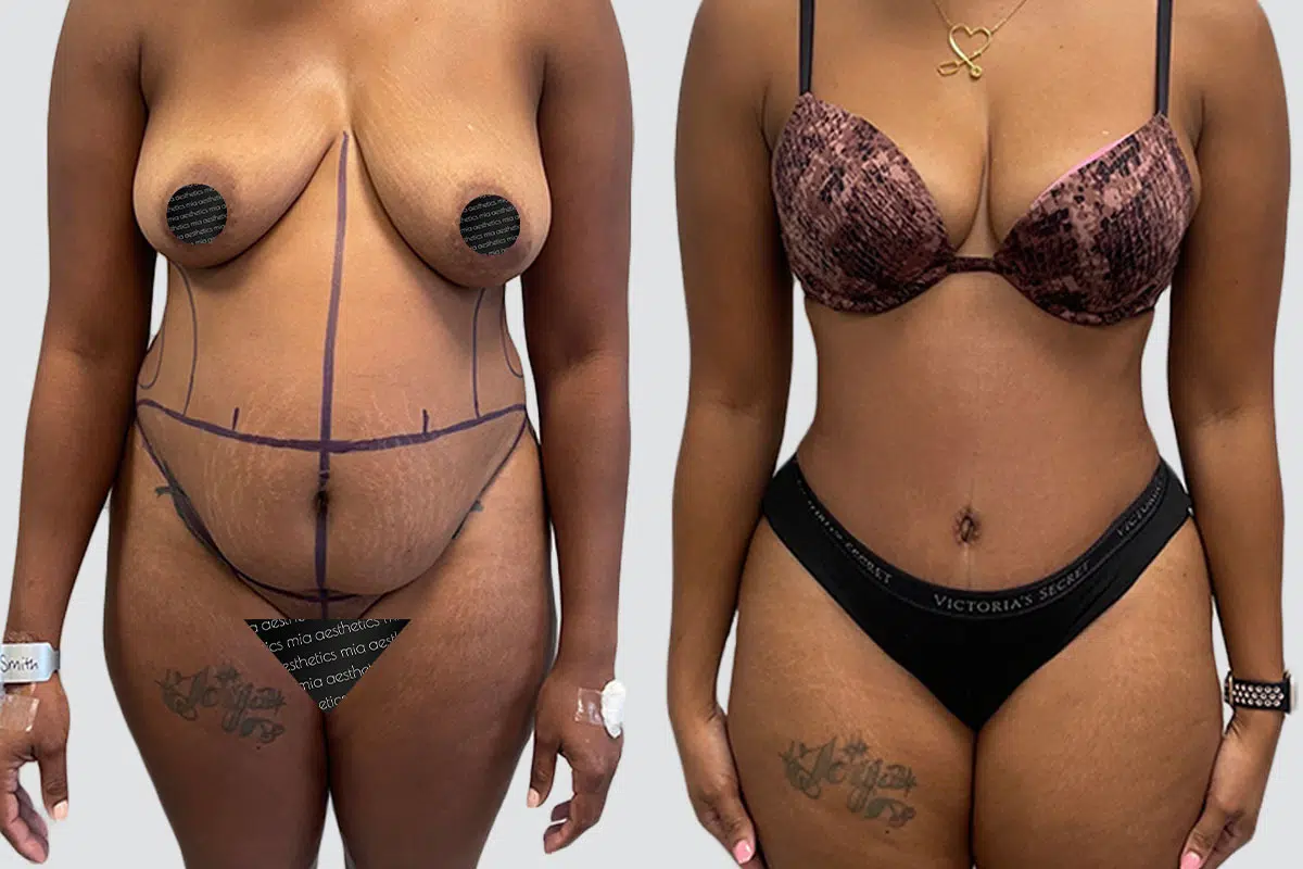 Tummy Tuck result at Mia Aesthetics