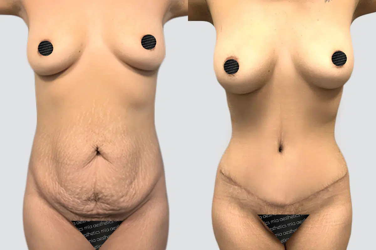 Tummy Tuck result at Mia Aesthetics