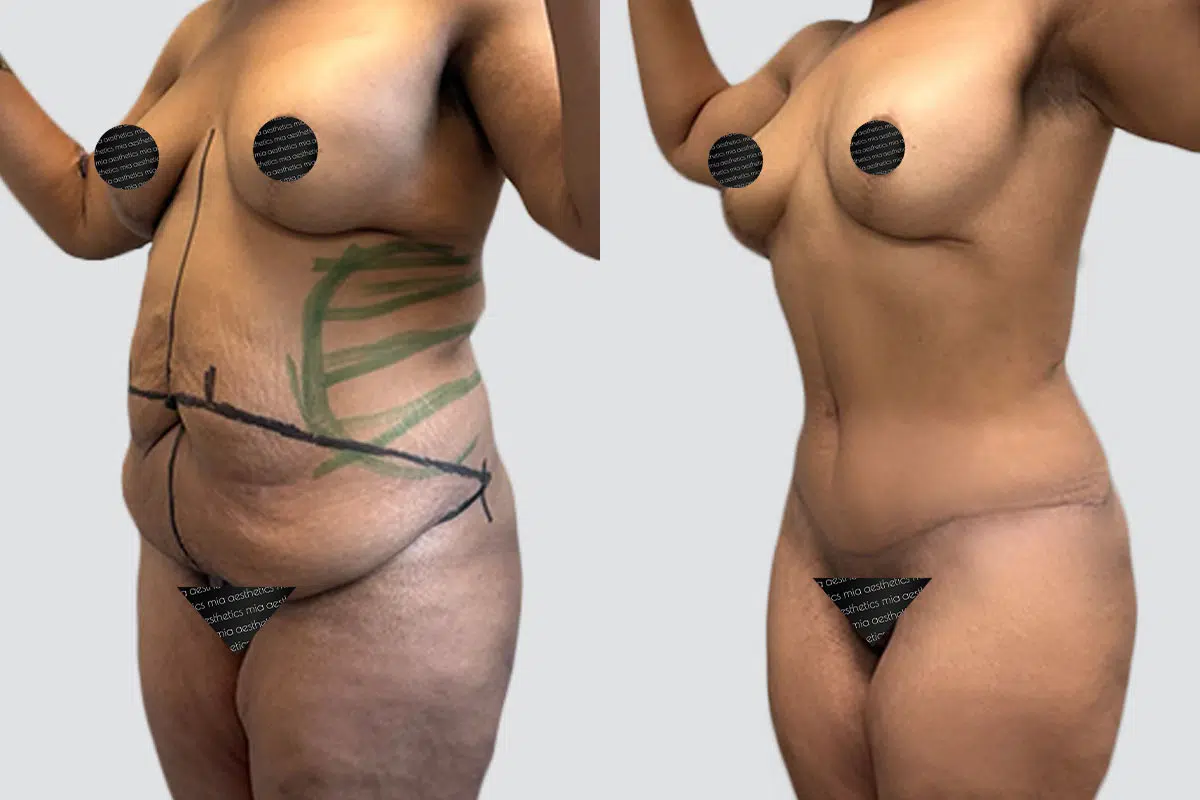 Tummy Tuck result at Mia Aesthetics