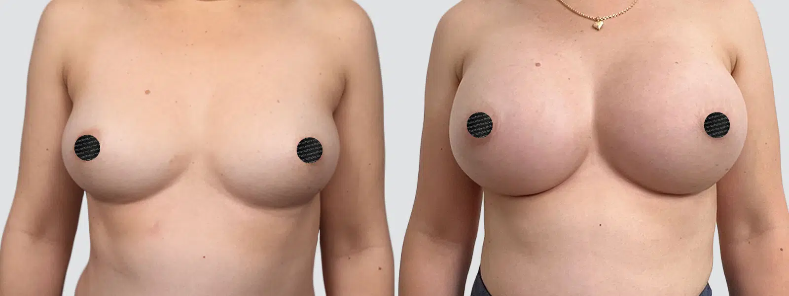Breast Augmentation result at Mia Aesthetics