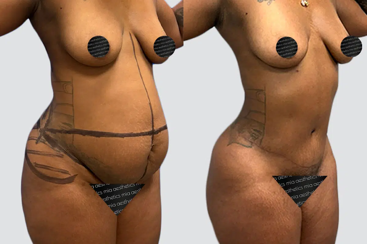 Tummy Tuck result at Mia Aesthetics