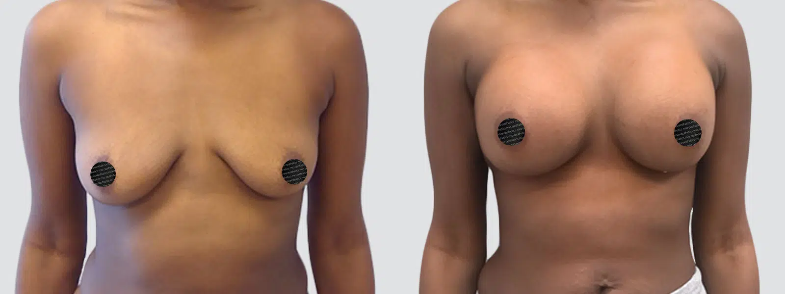 Breast Augmentation result at Mia Aesthetics