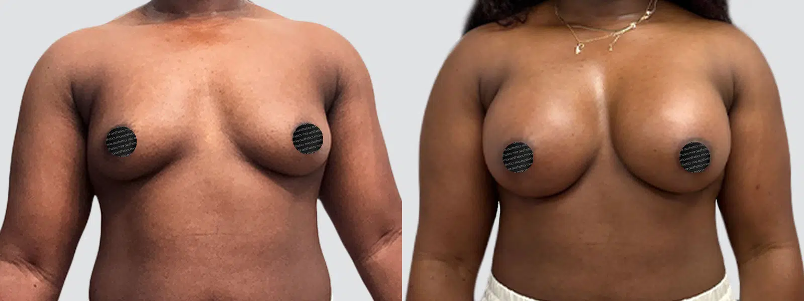 Breast Augmentation result at Mia Aesthetics