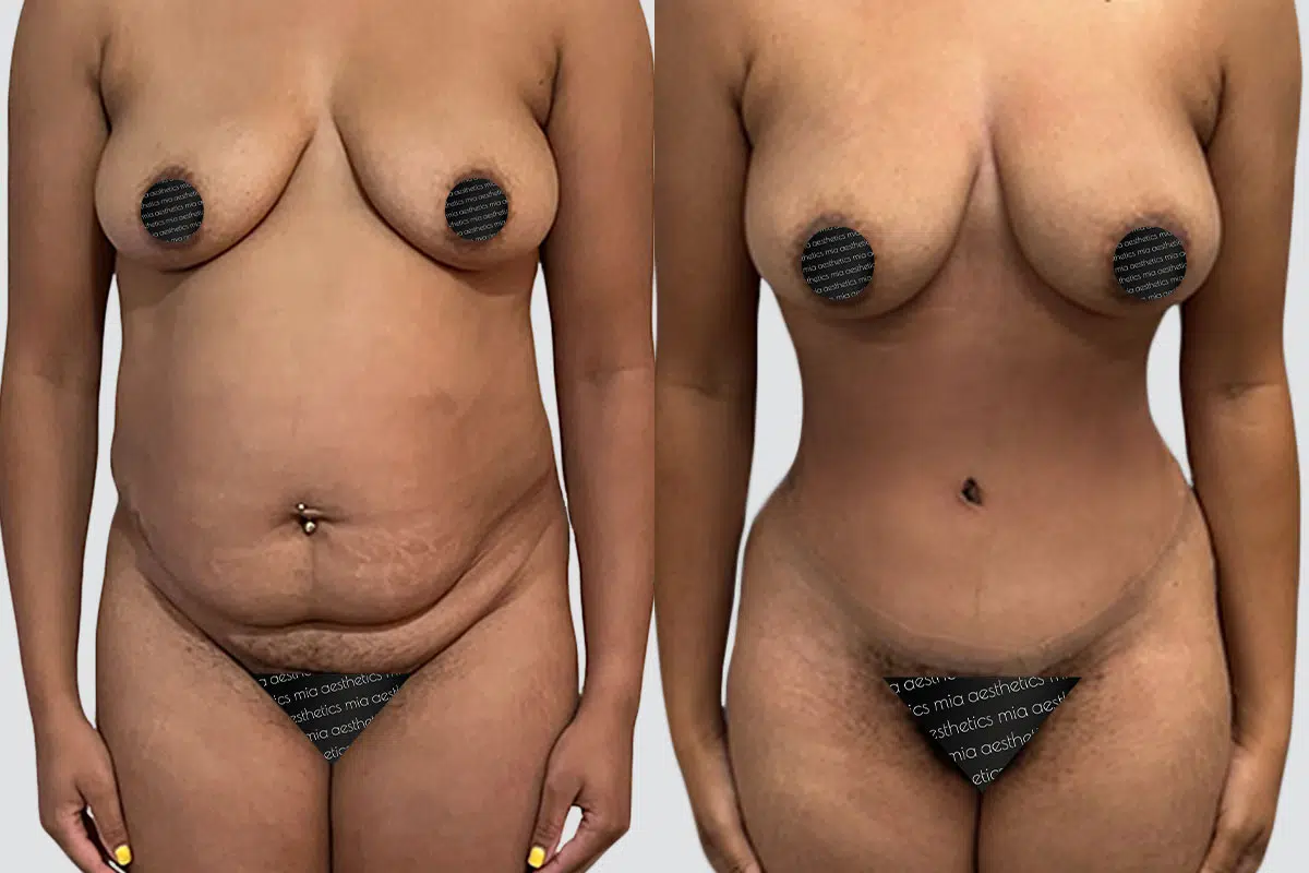 Tummy Tuck result at Mia Aesthetics