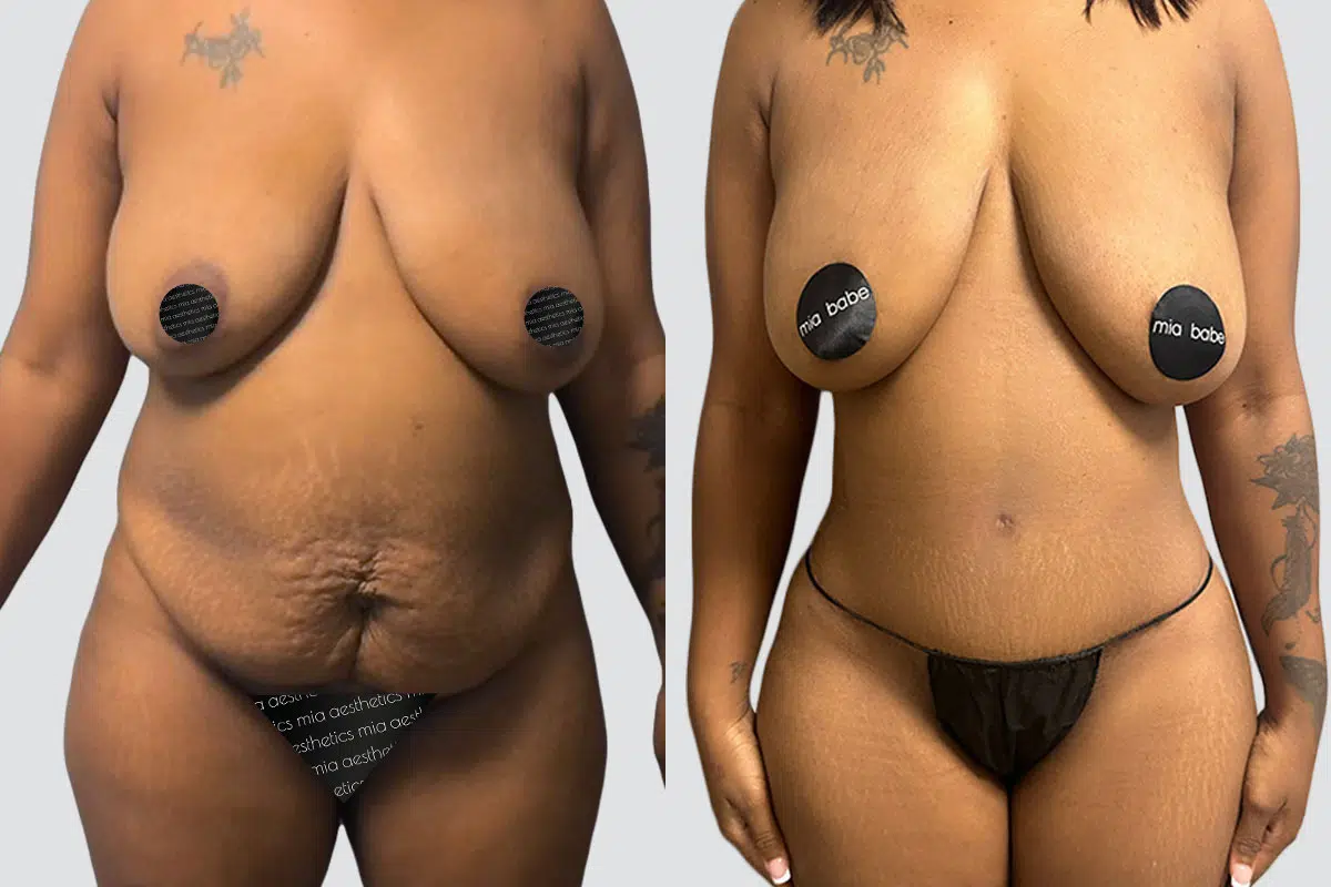 Tummy Tuck result at Mia Aesthetics