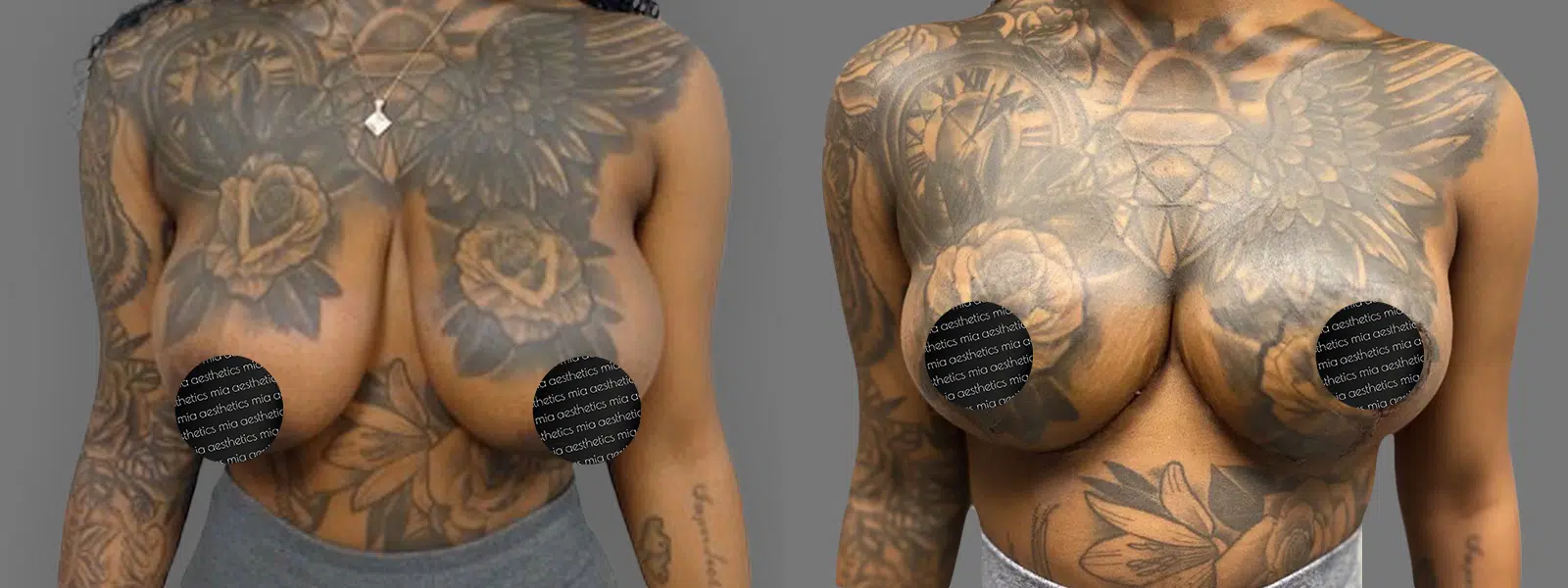 Breast Reduction result at Mia Aesthetics