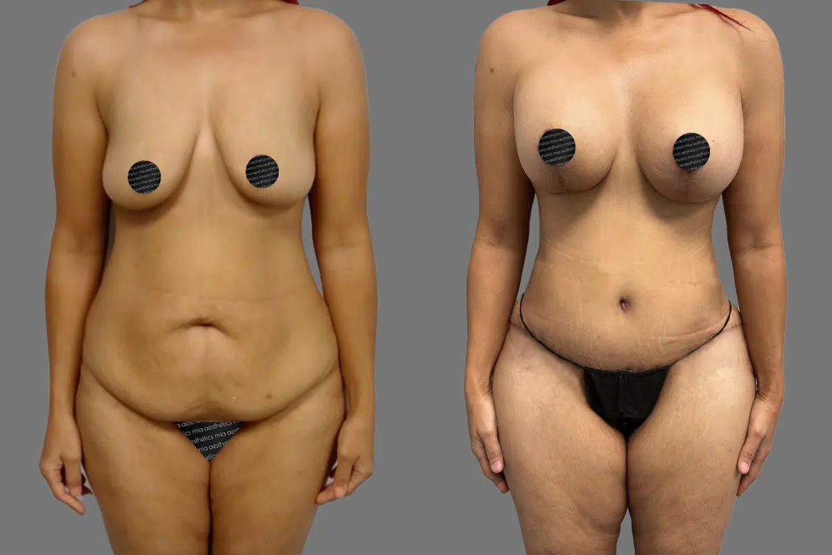Mommy Makeover result at Mia Aesthetics