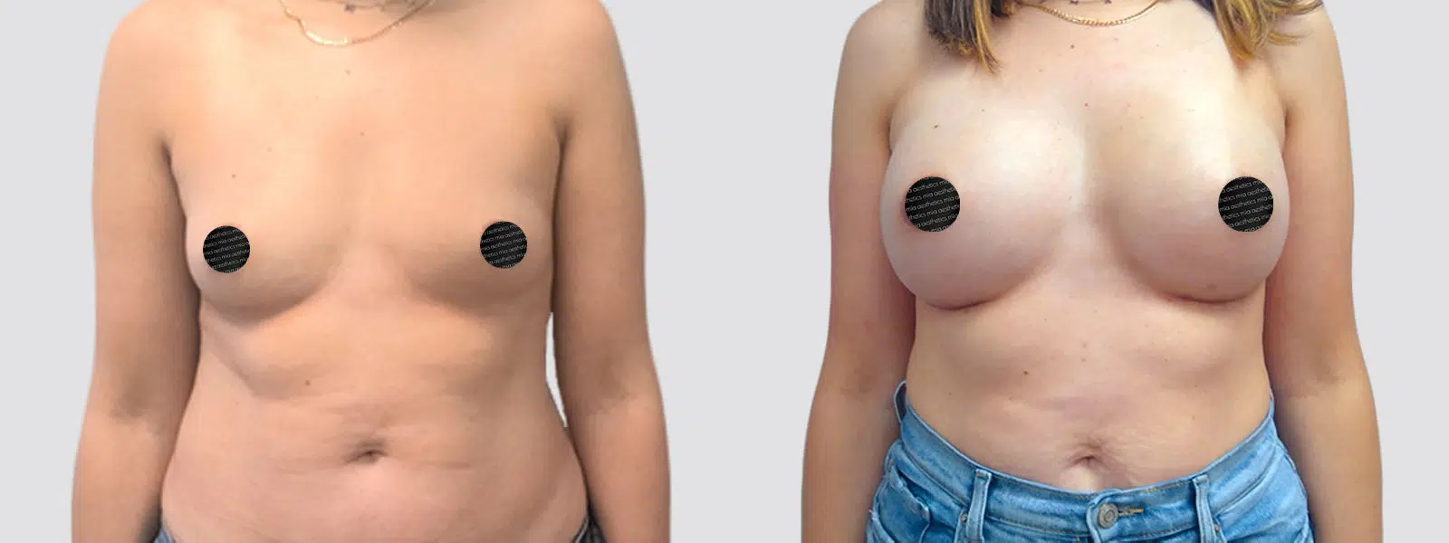 Breast Augmentation result at Mia Aesthetics